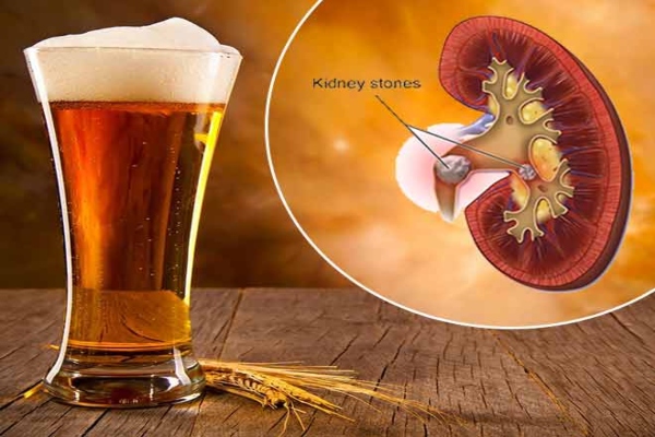 Is Non Alcoholic Beer Good for Kidney Stones